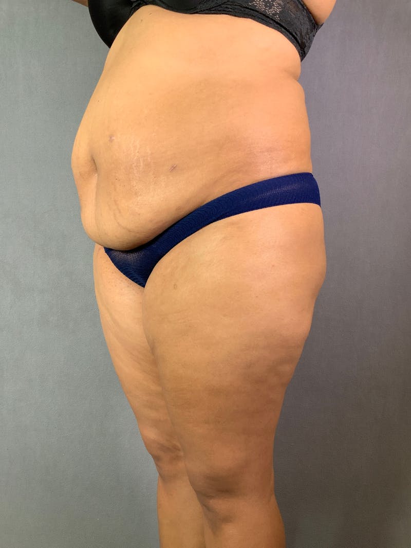Vertical (Fleur de lis) Tummy Tuck Before & After Gallery - Patient 167402567 - Image 3