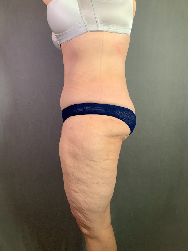 Vertical (Fleur de lis) Tummy Tuck Before & After Gallery - Patient 167402567 - Image 6