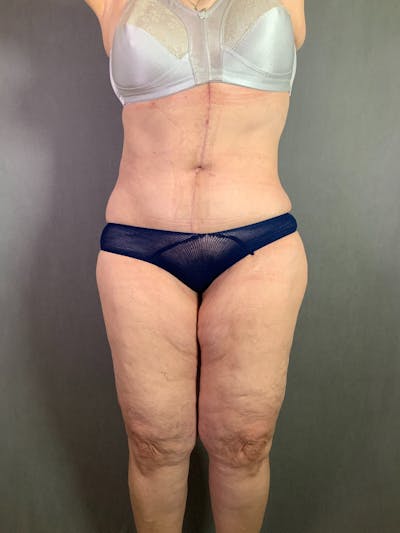 Vertical (Fleur de lis) Tummy Tuck Before & After Gallery - Patient 167402567 - Image 2