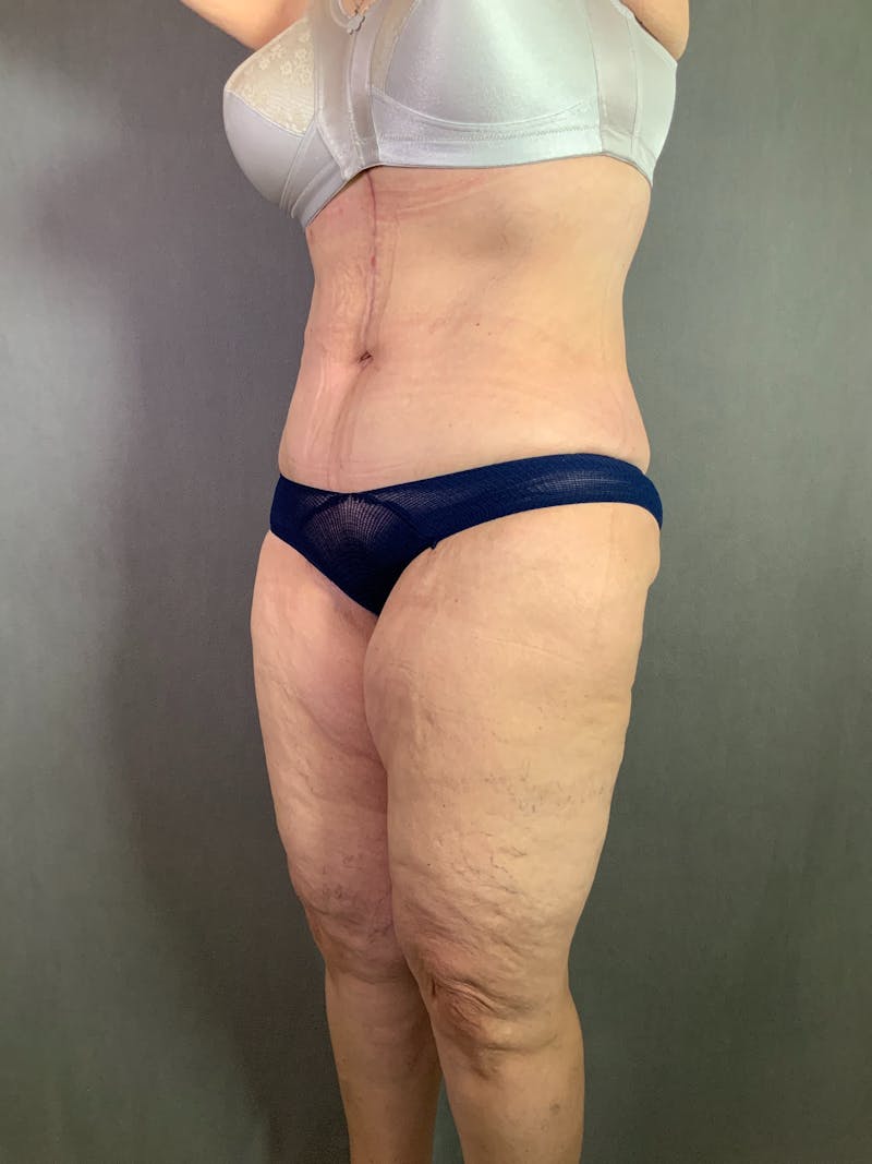Vertical (Fleur de lis) Tummy Tuck Before & After Gallery - Patient 167402567 - Image 4
