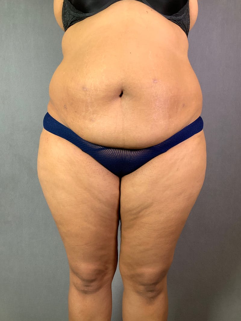 Vertical (Fleur de lis) Tummy Tuck Before & After Gallery - Patient 167402567 - Image 1