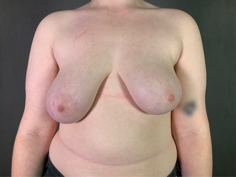 Top Surgery (Female to Male) Before & After Gallery - Patient 166979224 - Image 1