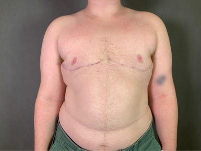 Top Surgery (Female to Male) Before & After Gallery - Patient 166979224 - Image 2