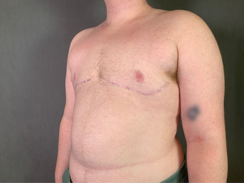Top Surgery (Female to Male) Before & After Gallery - Patient 166979224 - Image 4