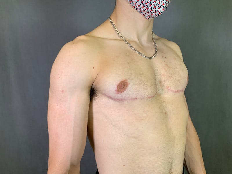 Top Surgery (Female to Male) Before & After Gallery - Patient 166979246 - Image 4