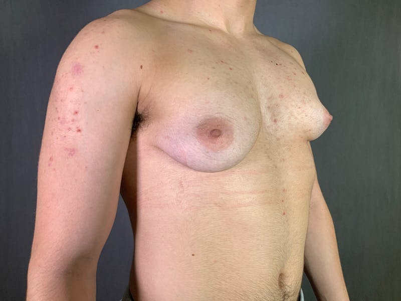 Top Surgery (Female to Male) Before & After Gallery - Patient 166979246 - Image 3