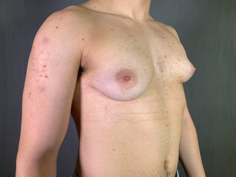 Top Surgery (Female to Male) Before & After Gallery - Patient 166979246 - Image 3