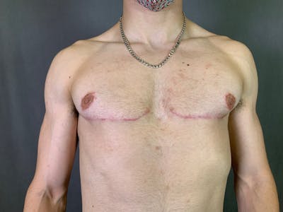 Top Surgery (Female to Male) Before & After Gallery - Patient 166979246 - Image 2