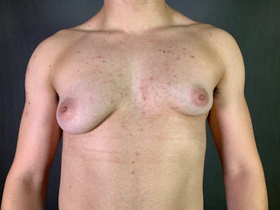 Top Surgery (Female to Male) Before & After Gallery - Patient 166979246 - Image 1