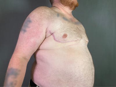 Top Surgery (Female to Male) Before & After Gallery - Patient 166979247 - Image 2