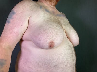Top Surgery (Female to Male) Before & After Gallery - Patient 166979247 - Image 1