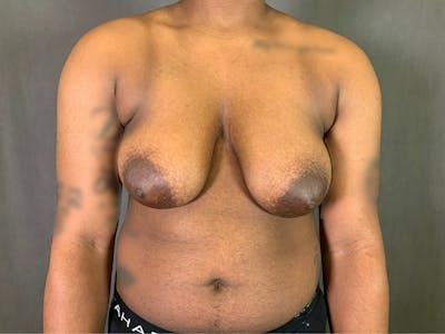 Top Surgery (Female to Male) Before & After Gallery - Patient 166979248 - Image 1