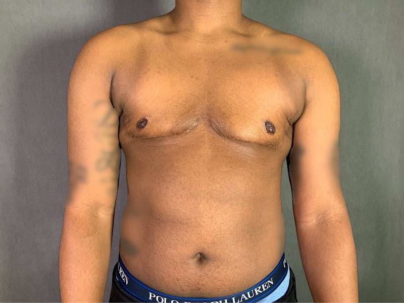 Top Surgery (Female to Male) Before & After Gallery - Patient 166979248 - Image 2