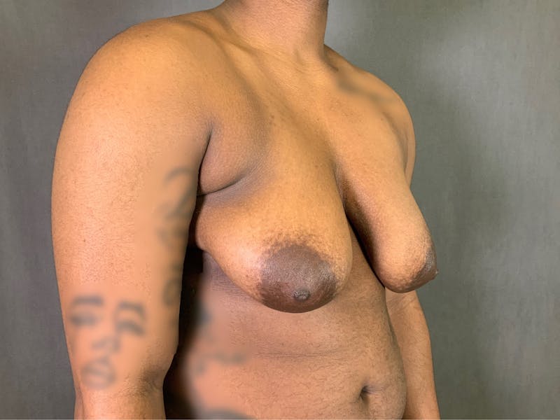 Top Surgery (Female to Male) Before & After Gallery - Patient 166979248 - Image 3