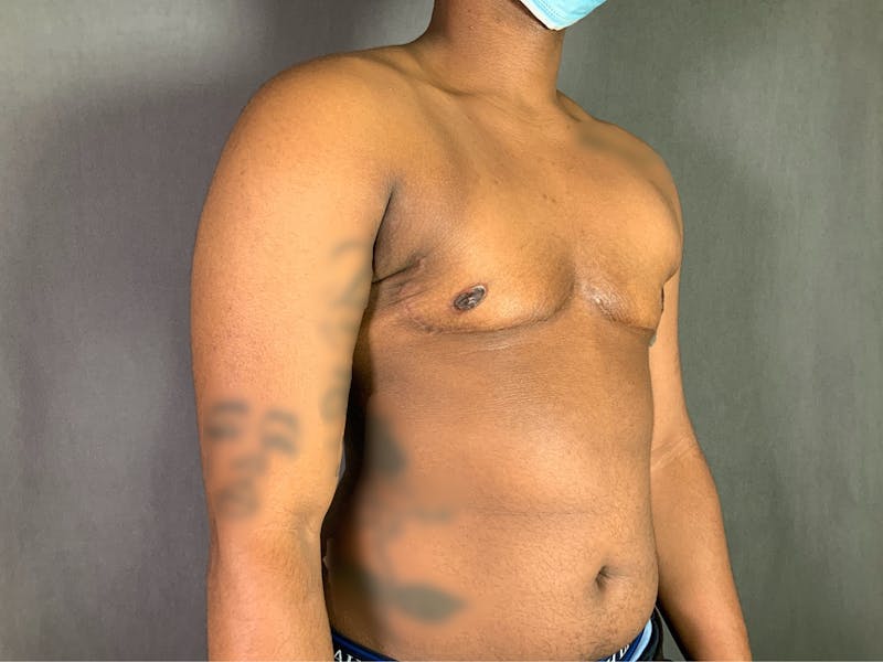 Top Surgery (Female to Male) Before & After Gallery - Patient 166979248 - Image 4