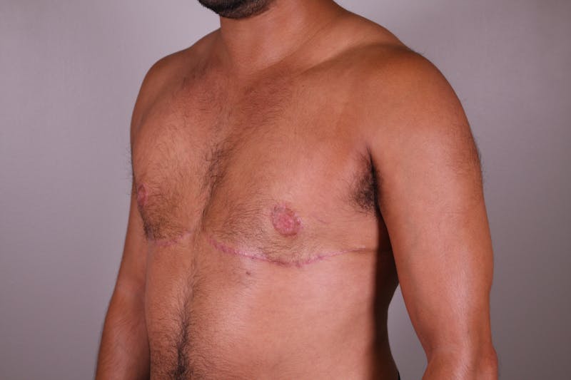Top Surgery (Female to Male) Before & After Gallery - Patient 166979254 - Image 4