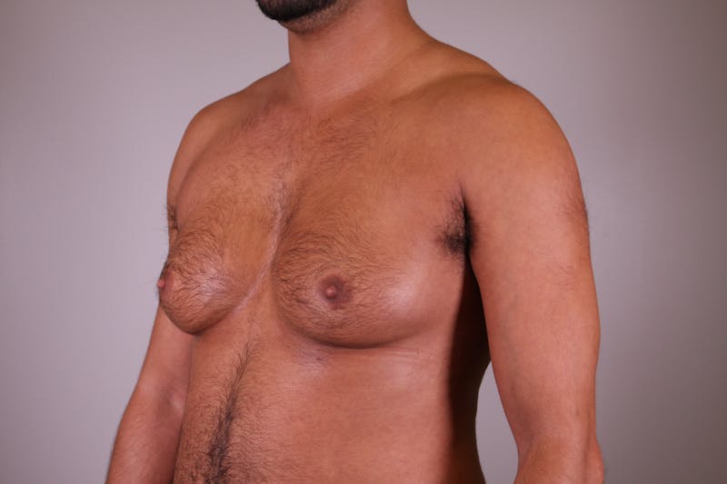 Top Surgery (Female to Male) Before & After Gallery - Patient 166979254 - Image 3