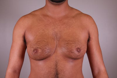 Top Surgery (Female to Male) Before & After Gallery - Patient 166979254 - Image 1
