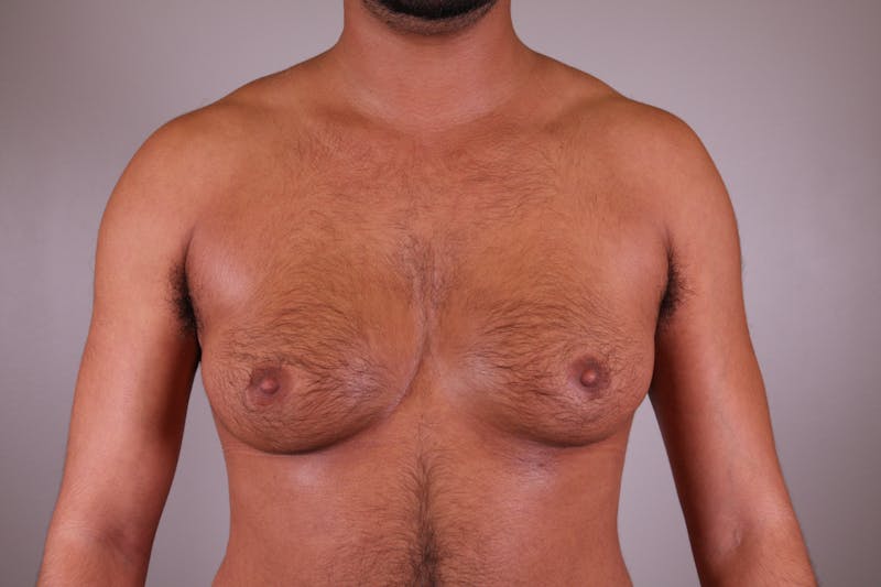 Top Surgery (Female to Male) Before & After Gallery - Patient 166979254 - Image 1