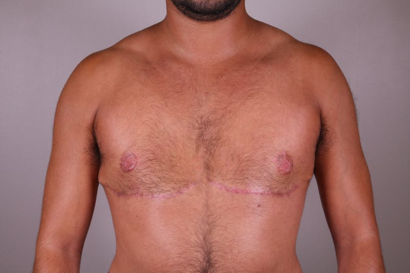 Top Surgery (Female to Male) Before & After Gallery - Patient 166979254 - Image 2