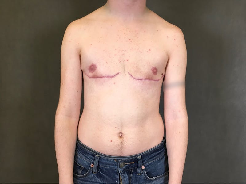 Top Surgery (Female to Male) Before & After Gallery - Patient 166979255 - Image 2