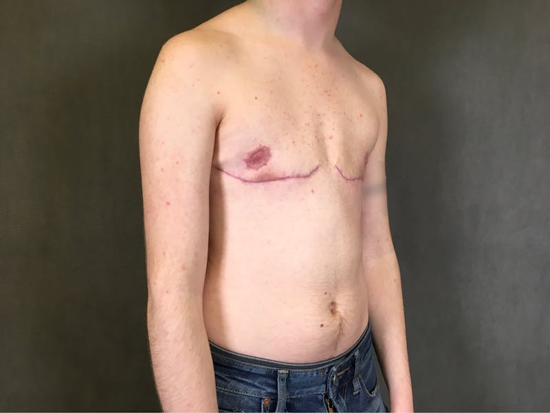 Top Surgery (Female to Male) Before & After Gallery - Patient 166979255 - Image 4
