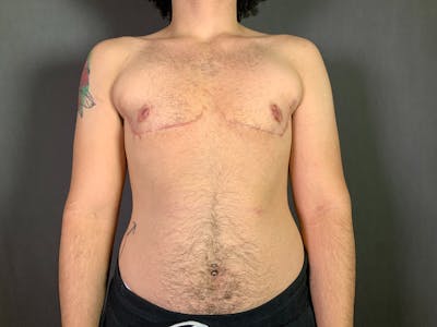 Top Surgery (Female to Male) Before & After Gallery - Patient 166979261 - Image 2