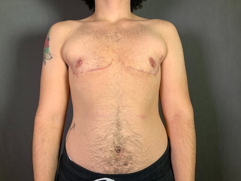 Top Surgery (Female to Male) Before & After Gallery - Patient 166979261 - Image 2