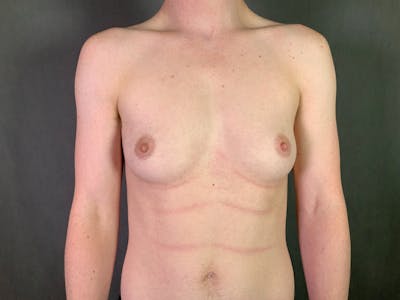 Top Surgery (Female to Male) Before & After Gallery - Patient 166979263 - Image 1