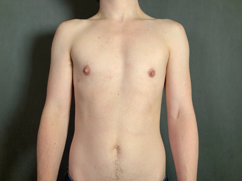 Top Surgery (Female to Male) Before & After Gallery - Patient 166979263 - Image 2