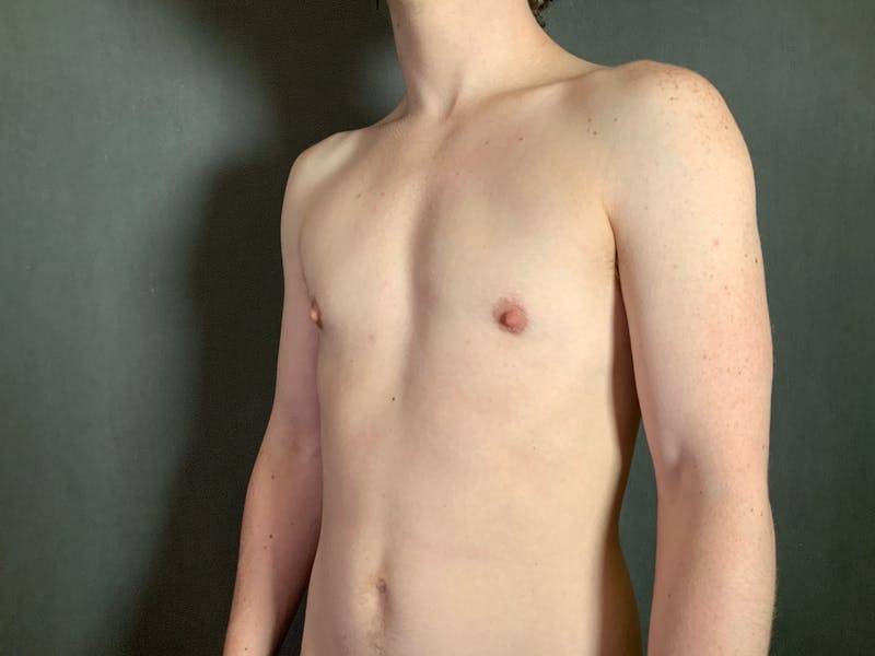 Top Surgery (Female to Male) Before & After Gallery - Patient 166979263 - Image 4