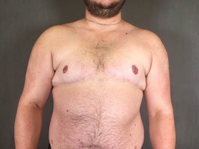 Top Surgery (Female to Male) Before & After Gallery - Patient 166979265 - Image 2