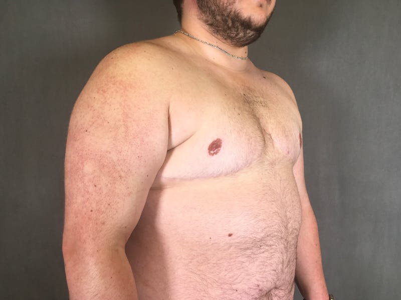 Top Surgery (Female to Male) Before & After Gallery - Patient 166979265 - Image 4