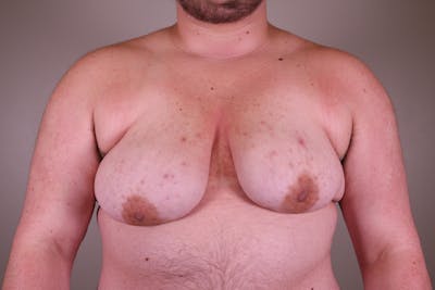 Top Surgery (Female to Male) Before & After Gallery - Patient 166979265 - Image 1