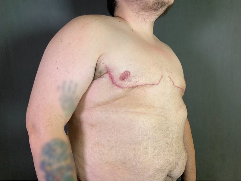 Top Surgery (Female to Male) Before & After Gallery - Patient 166979266 - Image 4