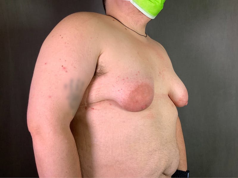 Top Surgery (Female to Male) Before & After Gallery - Patient 166979266 - Image 3