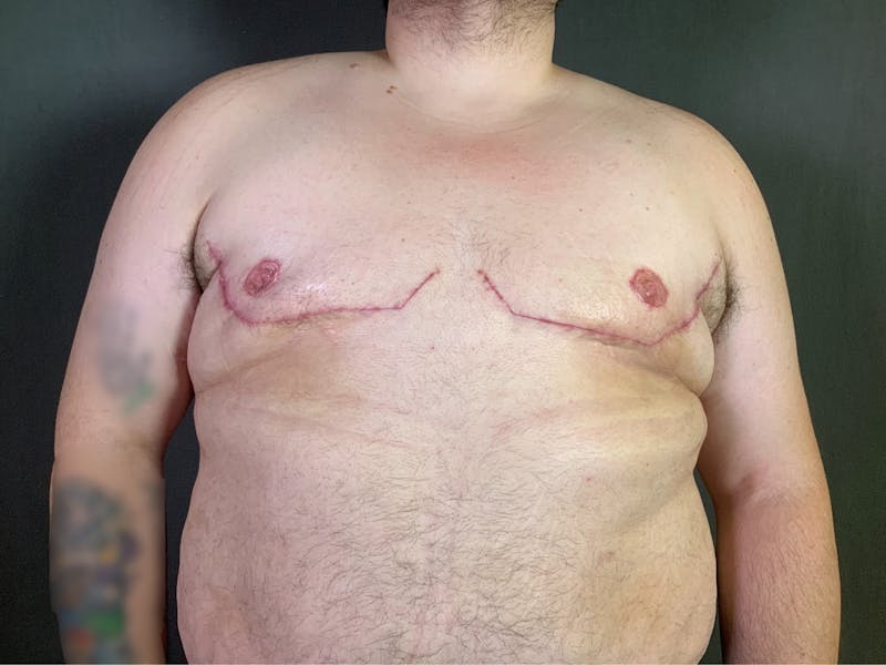 Top Surgery (Female to Male) Before & After Gallery - Patient 166979266 - Image 2