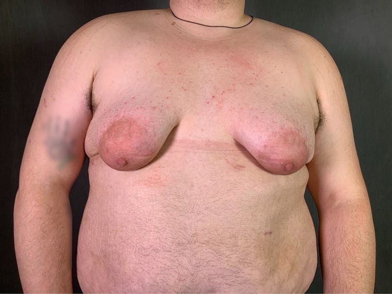 Top Surgery (Female to Male) Before & After Gallery - Patient 166979266 - Image 1