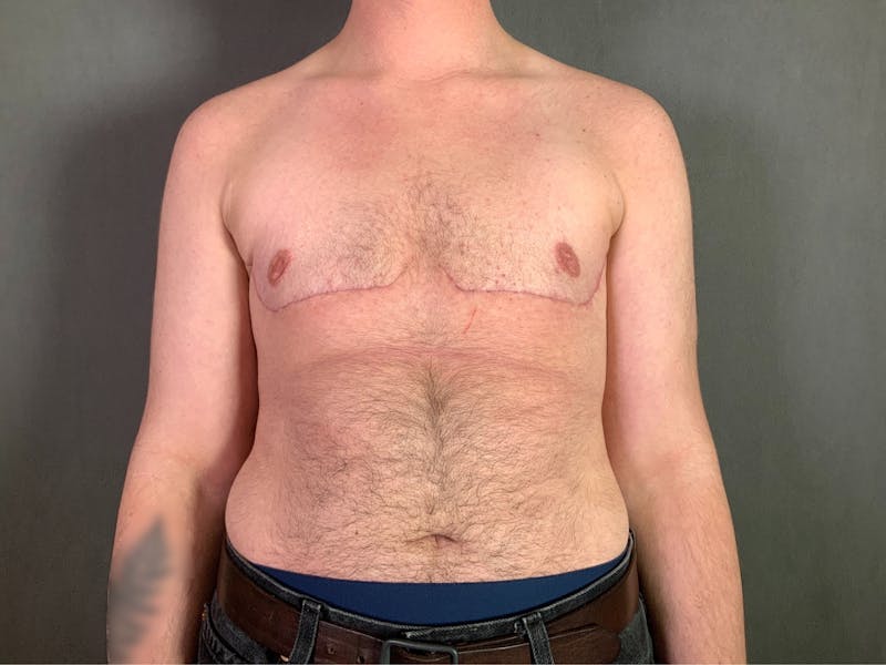 Top Surgery (Female to Male) Before & After Gallery - Patient 166979267 - Image 2