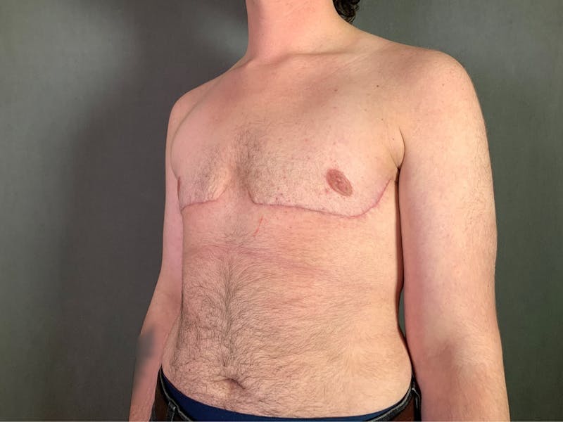 Top Surgery (Female to Male) Before & After Gallery - Patient 166979267 - Image 4