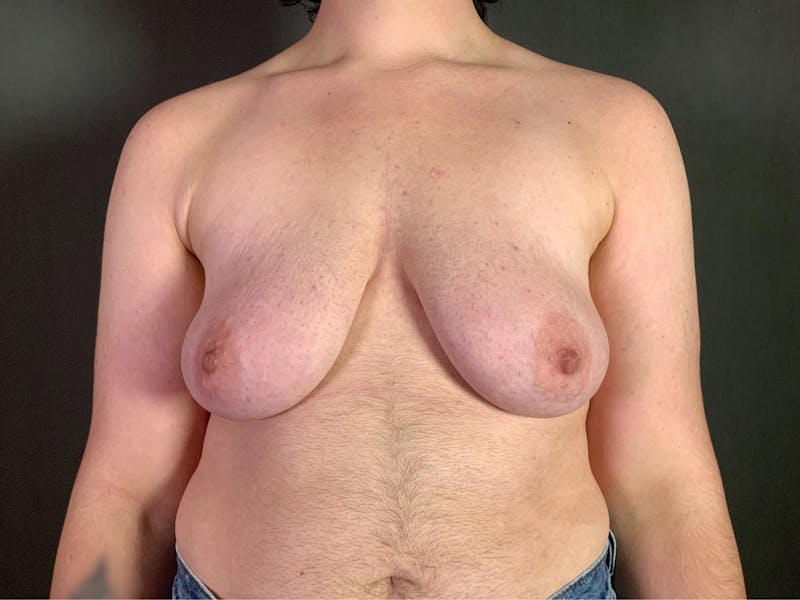 Top Surgery (Female to Male) Before & After Gallery - Patient 166979267 - Image 1