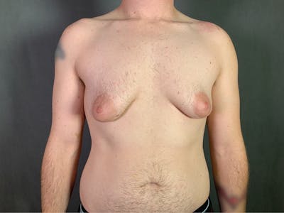 Top Surgery (Female to Male) Before & After Gallery - Patient 166979268 - Image 1