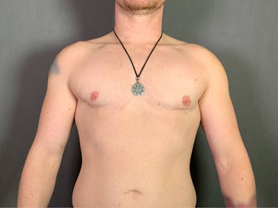 Top Surgery (Female to Male) Before & After Gallery - Patient 166979268 - Image 2