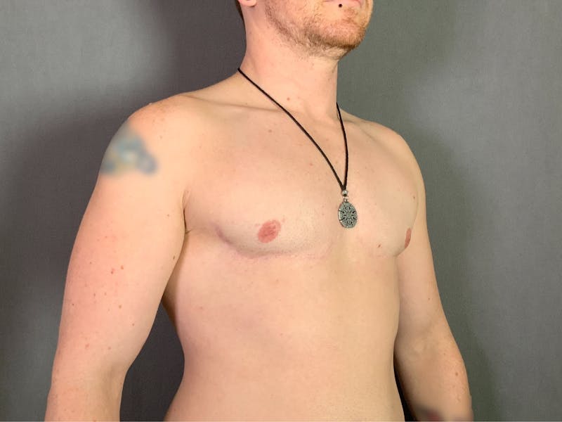 Top Surgery (Female to Male) Before & After Gallery - Patient 166979268 - Image 4