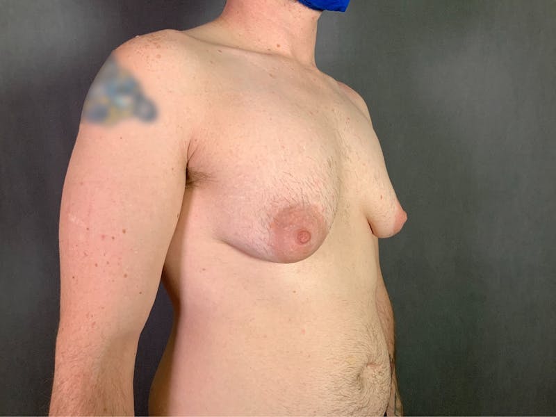Top Surgery (Female to Male) Before & After Gallery - Patient 166979268 - Image 3