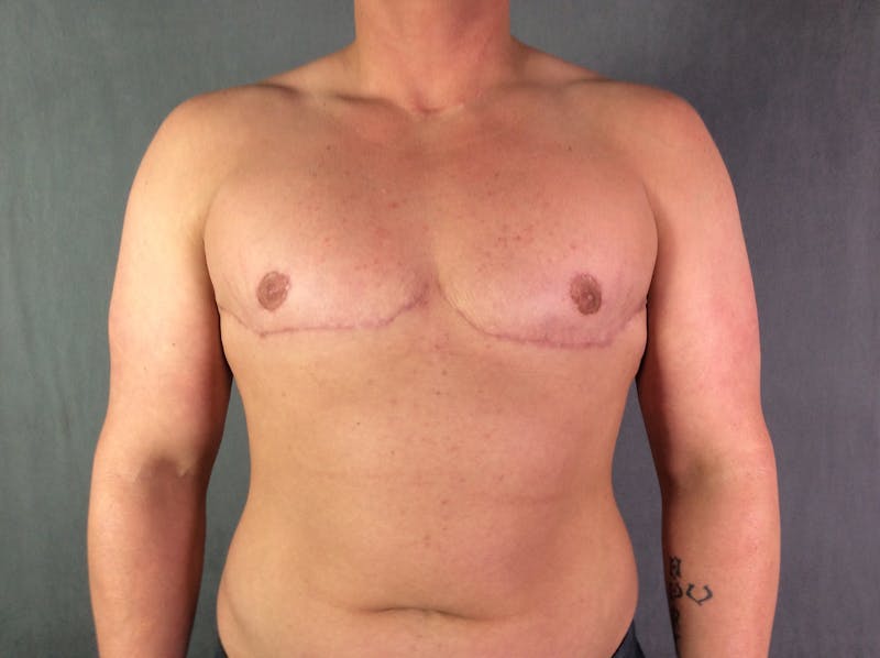 Top Surgery (Female to Male) Before & After Gallery - Patient 166979269 - Image 2