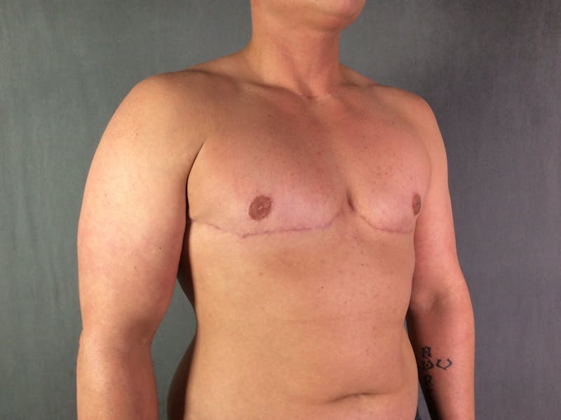 Top Surgery (Female to Male) Before & After Gallery - Patient 166979269 - Image 4