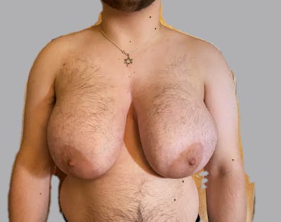 Top Surgery (Female to Male) Before & After Gallery - Patient 166979273 - Image 1
