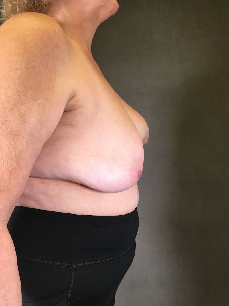 Breast Implant Revision Before & After Gallery - Patient 166979369 - Image 3