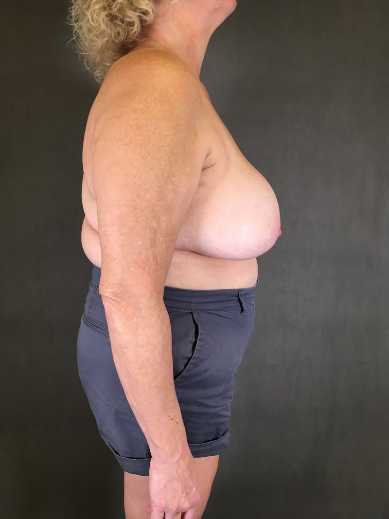 Breast Implant Revision Before & After Gallery - Patient 166979369 - Image 4